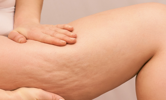 6 Tips To Help Reduce Cellulite